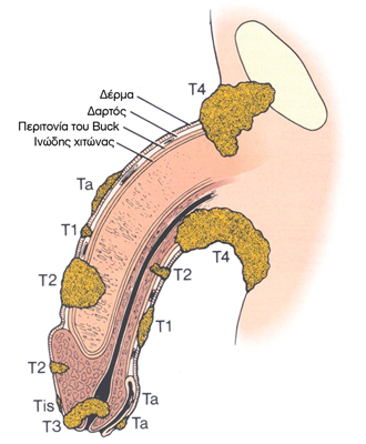 Penile Cancer ISUD